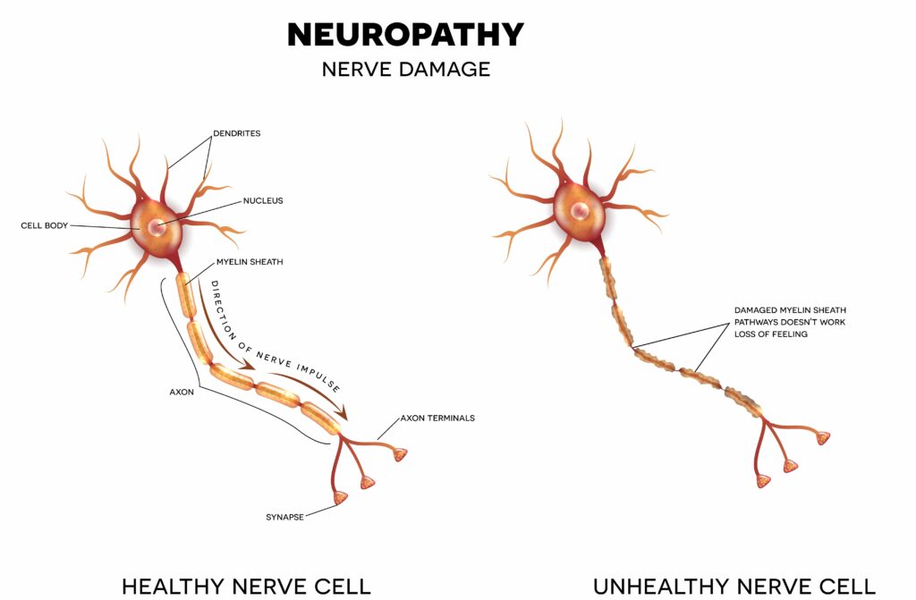 Neuropathy nerve damage comparing a healthy nerve cell and an unhealthy nerve cell.