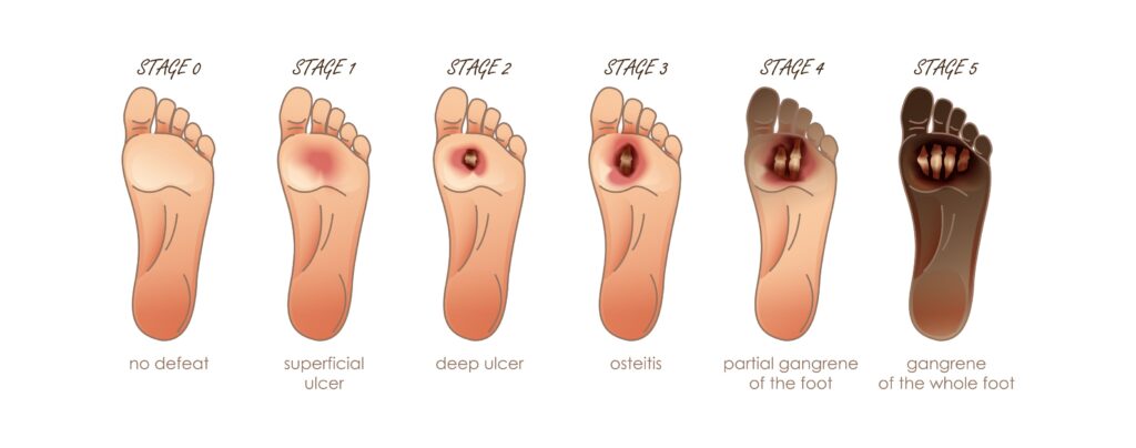 Pictures of feet at different stages as a diabetic.